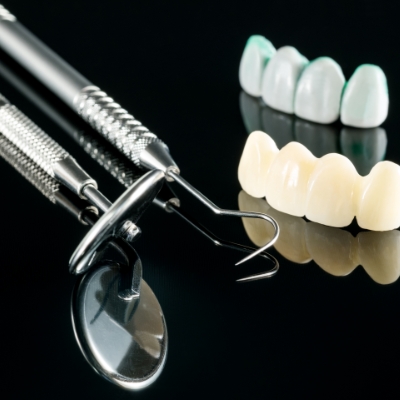  La pose d’un pont fixe sur des dents naturelles : quelques étapes pour un remplacement durable