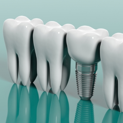 Le processus implantaire : quelques étapes pour un remplacement dentaire efficace